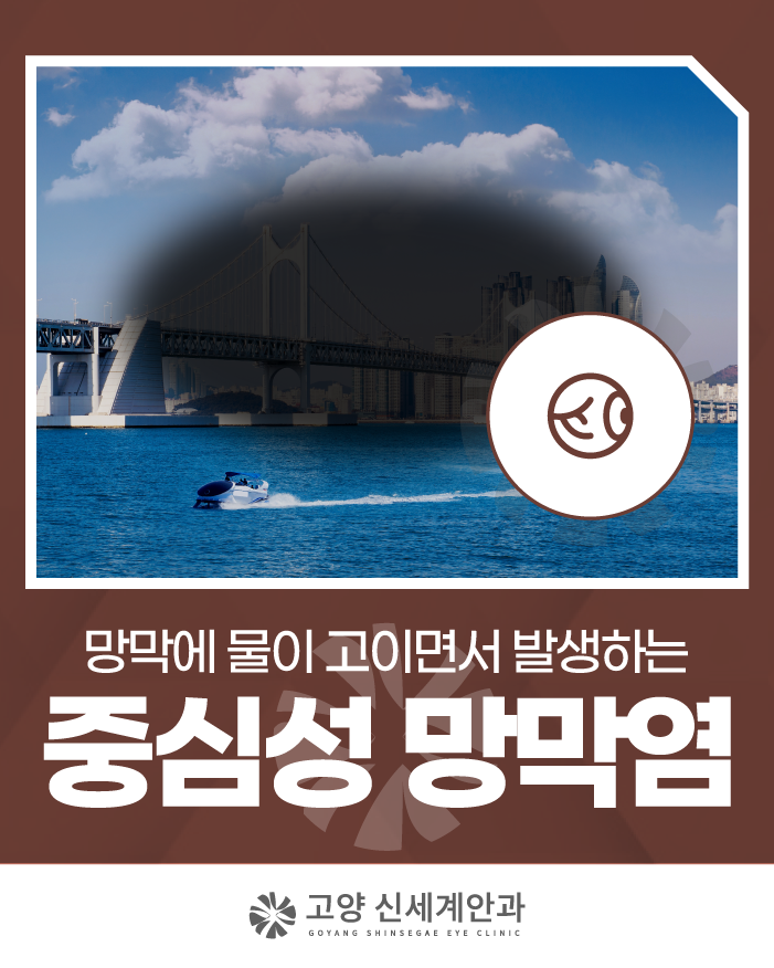 고양 중심성망막염, 시야 변화 느꼈다면 지금 알아야 할 내용